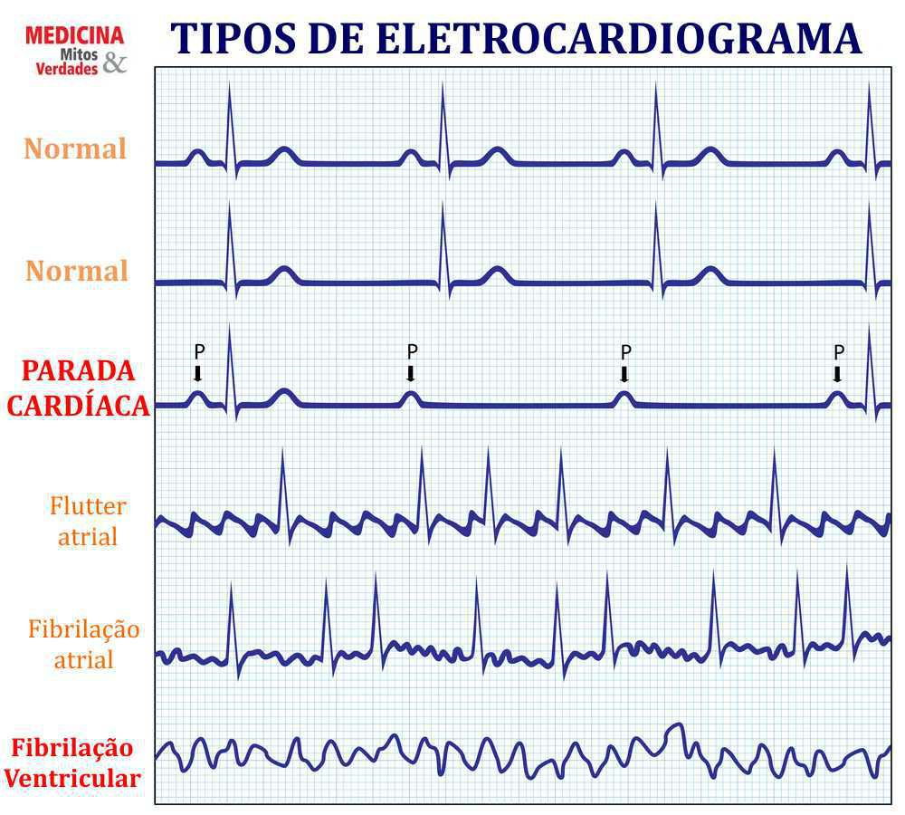 O Ritmo Certo: Bradicardia e Suas Implicações - inspiração 1