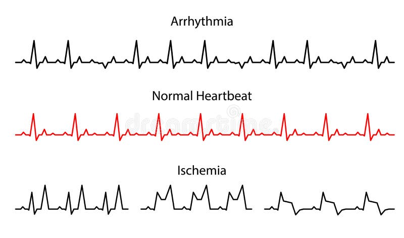 O Ritmo Certo: Bradicardia e Suas Implicações - inspiração 2