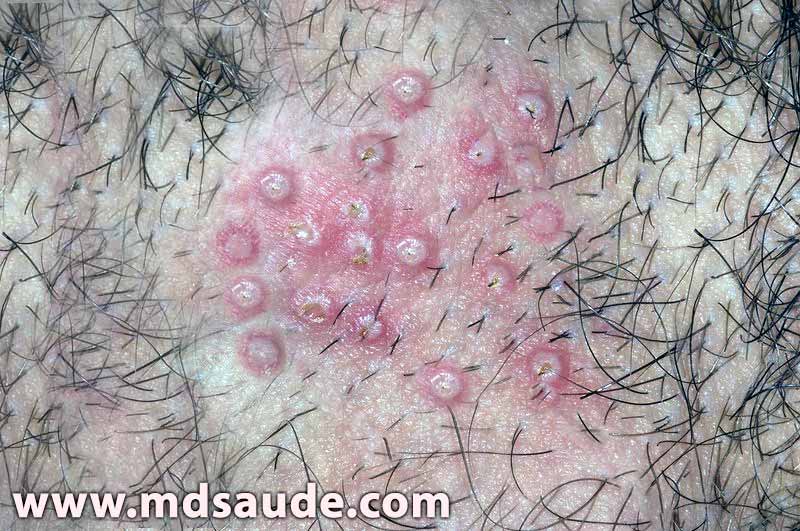 Alterações na Pele do Pênis: O Que Seu Corpo Está Tentando Dizer? - inspiração 1