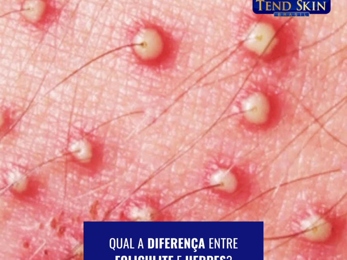 Alterações na Pele do Pênis: O Que Seu Corpo Está Tentando Dizer? - inspiração 2