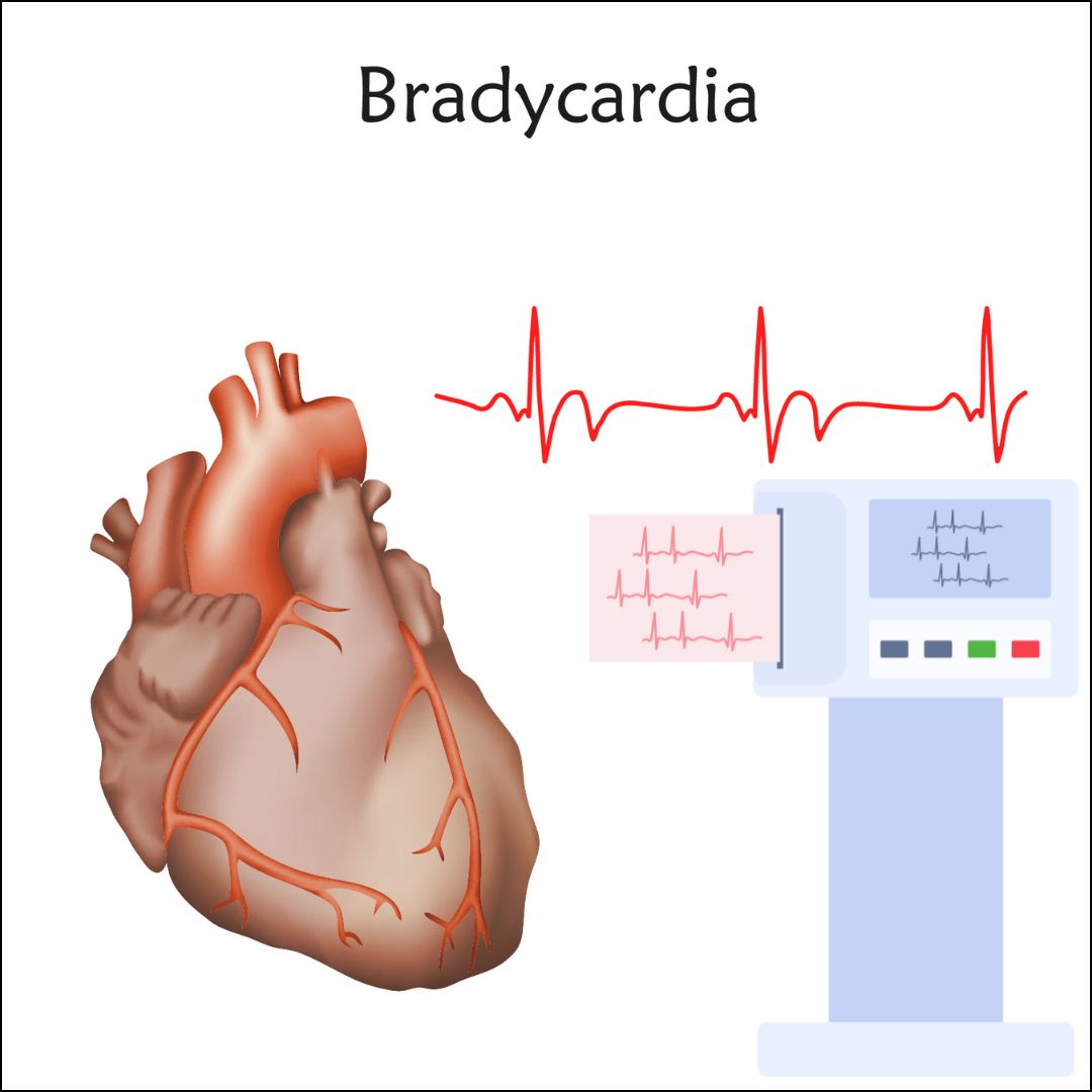 Os Sinais Discretos da Bradicardia: Fique Atenta! - inspiração 2