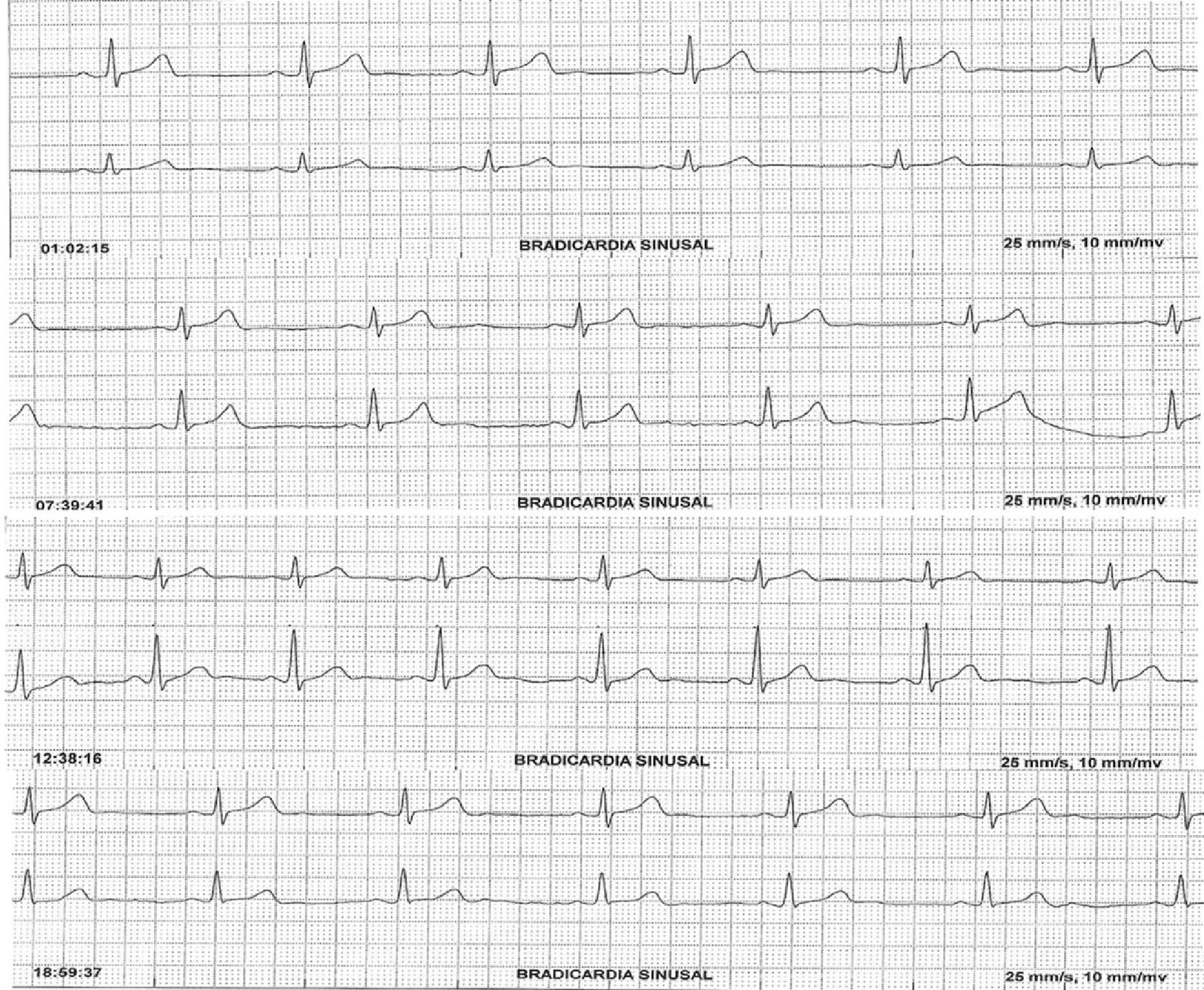 Quando a Bradicardia é Normal? - inspiração 2