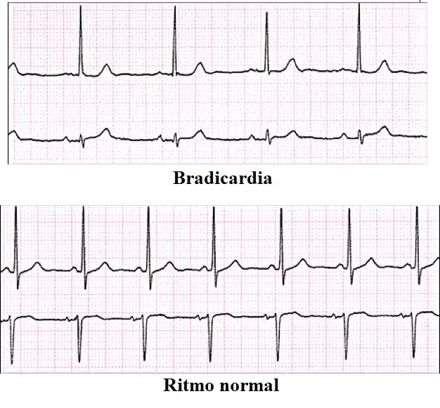 Bradicardia em Mulheres: Algumas Especificidades - inspiração 2