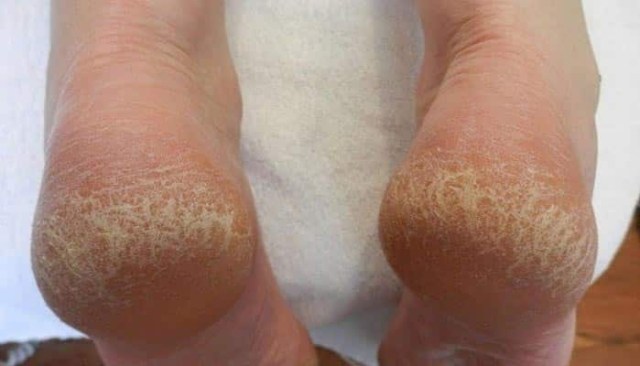 Identificando os primeiros sinais: como saber se seus calcanhares precisam de atenção extra? - inspiração 1