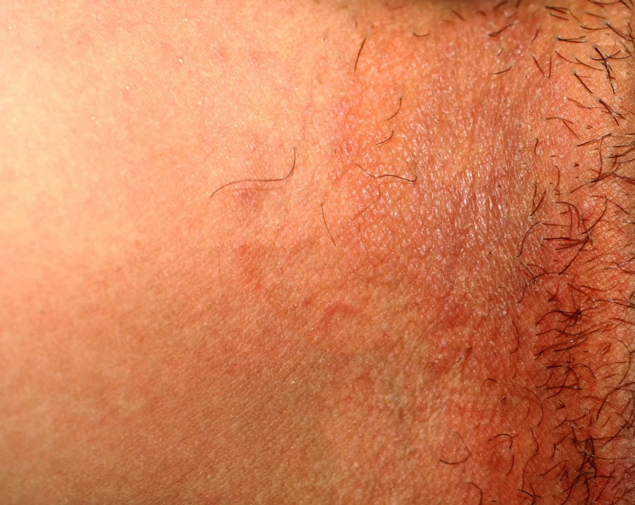 Irritação por Contato: Roupas Apertadas e Tecidos Sintéticos - inspiração 1