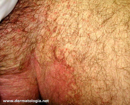 Doenças Sexualmente Transmissíveis: Quando Investigar Mais a Fundo - inspiração 1