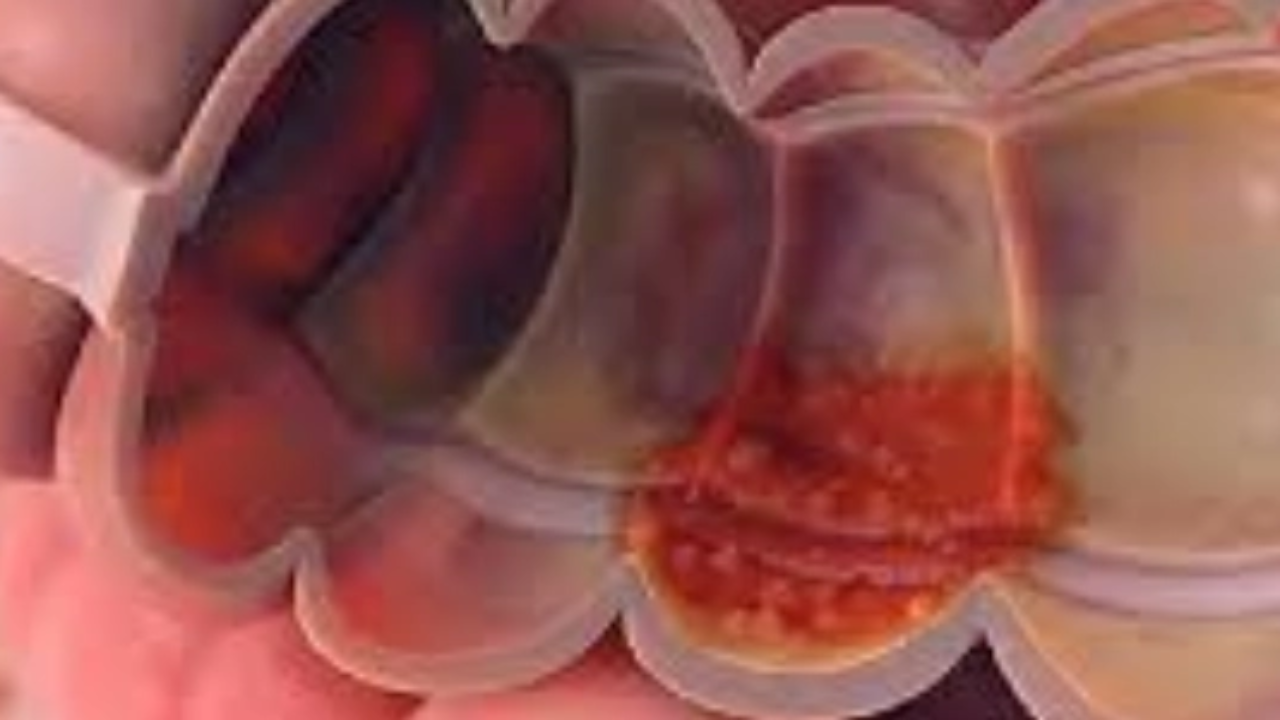 O que é Colite? Uma Explicação Clara - inspiração 2