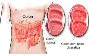 Tipos Comuns de Colite e Suas Diferenças - inspiração 1