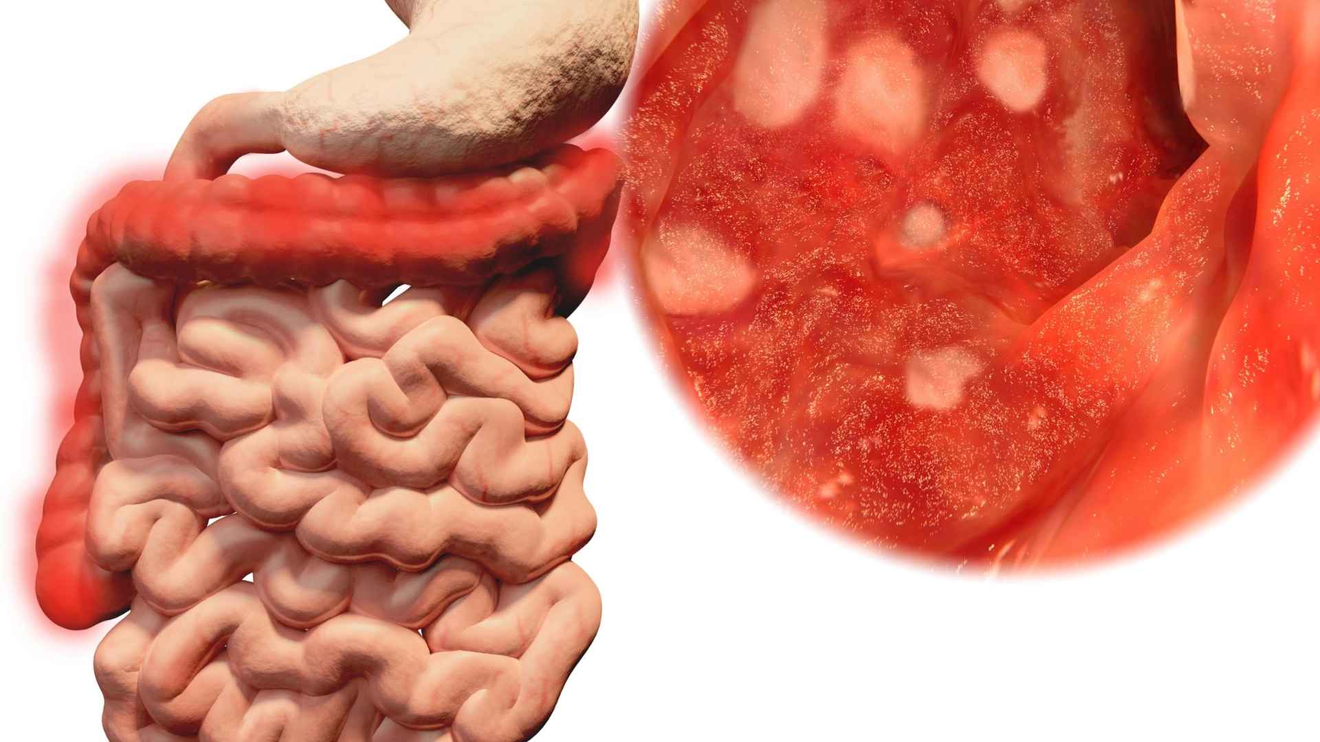 Diagnóstico: Como os Médicos Identificam a Colite? - inspiração 1