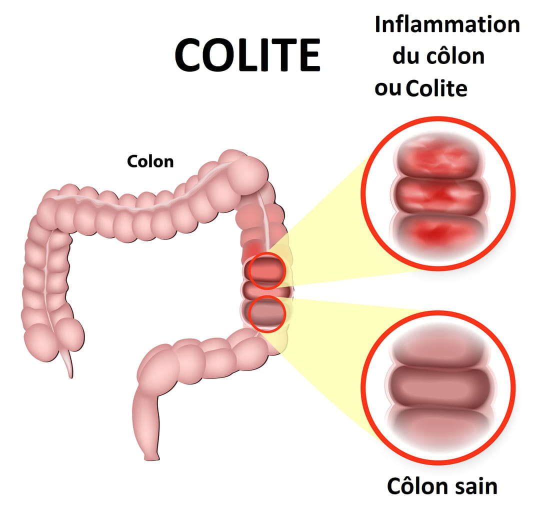 Tratamentos Disponíveis para Aliviar o Desconforto - inspiração 2