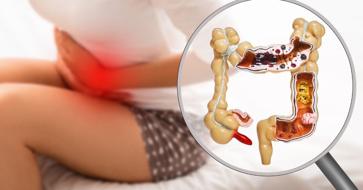 Colite e Rotina: Adaptando o Dia a Dia - inspiração 2