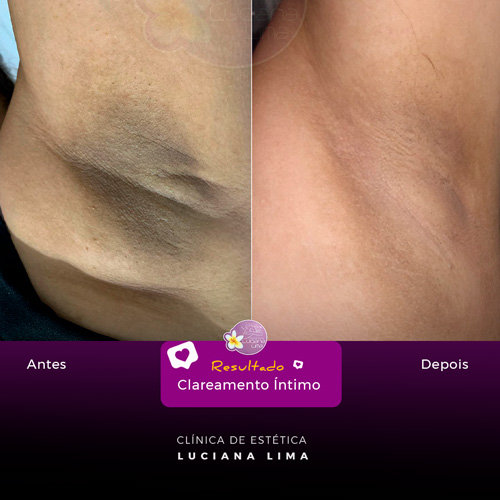 Hidratação é a Chave: Escolhendo o Hidratante Ideal Pós-Depilação - inspiração 2