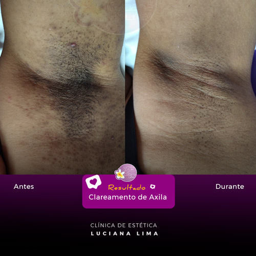 Atenção com a Depilação: Métodos que Menos Danificam a Pele das Axilas - inspiração 2