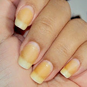 Óleo de Melaleuca: Para Unhas Saudáveis e Livres de Manchas - inspiração 1