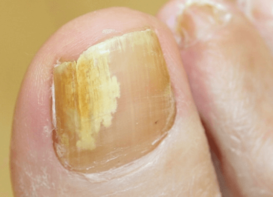 Esfoliação Suave: Removendo as Camadas Superficiais - inspiração 1