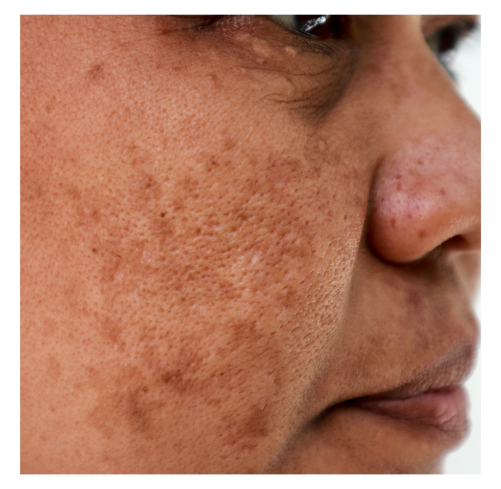 Entendendo os Tipos de Manchas no Rosto - inspiração 2