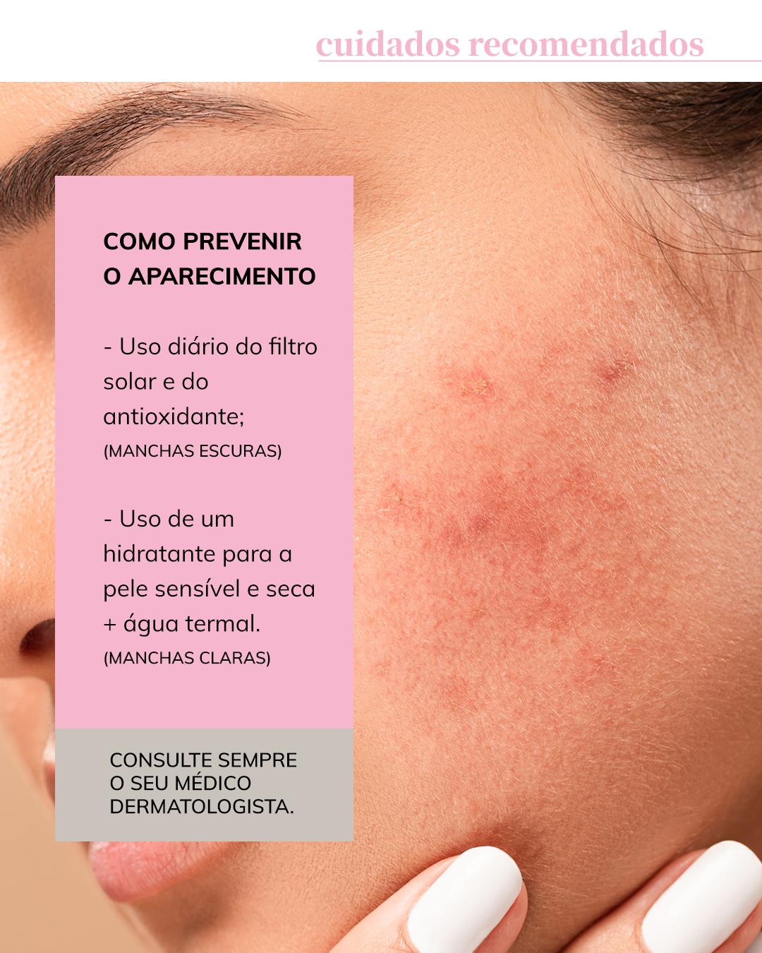 Manchas de Acne e Melasma: Estratégias Específicas - inspiração 1