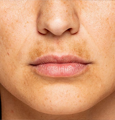 Causas Comuns: O Que Ativa o Surgimento das Manchas? - inspiração 2