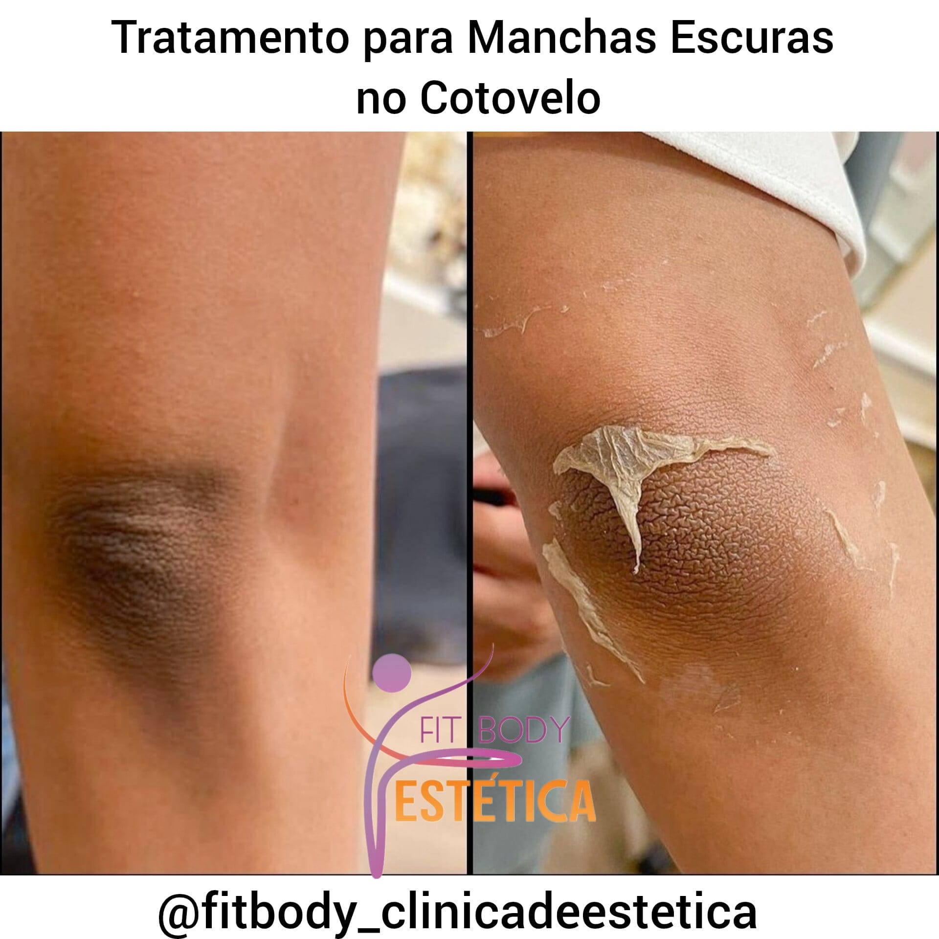 O Poder do Ácido Kójico e Alfa-Arbutin - inspiração 2