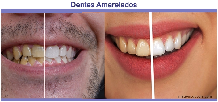 Quando Procurar um Dentista: Clareamento Profissional - inspiração 1