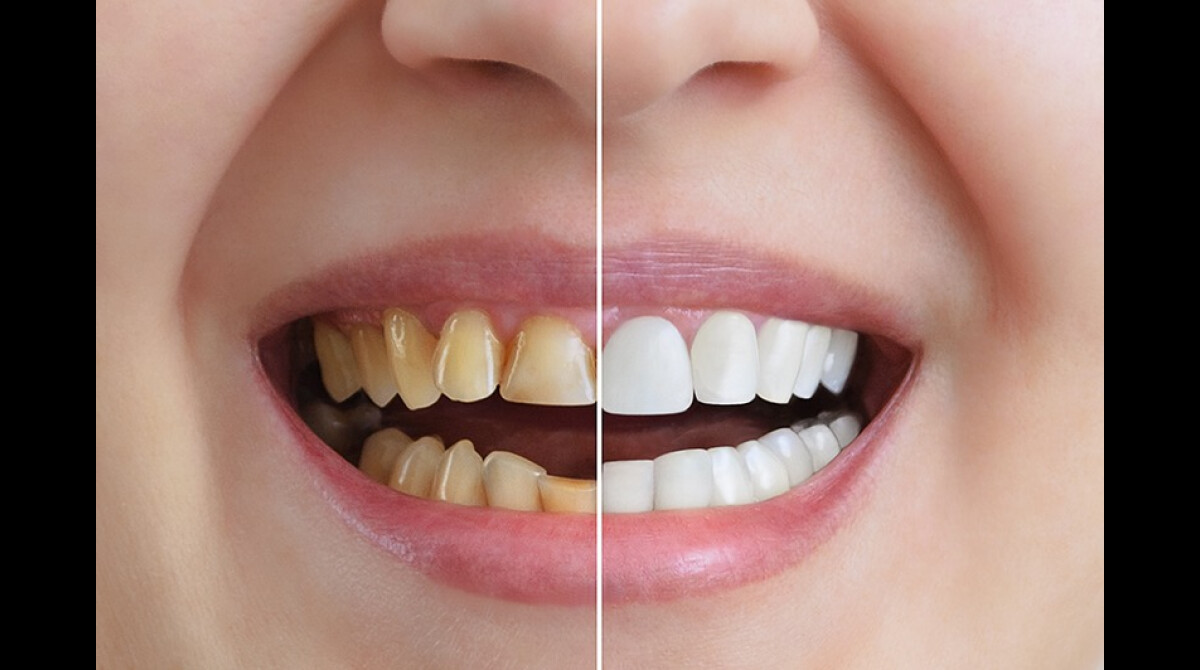 Gel Clareador: O Que Você Precisa Saber Antes de Comprar - inspiração 1