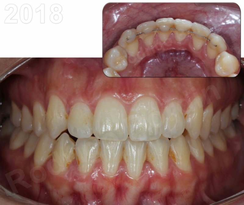 Gel Clareador: O Que Você Precisa Saber Antes de Comprar - inspiração 2