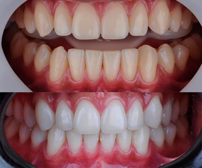 Pastas de Dente Clareadoras: Mais que Marketing? - inspiração 2