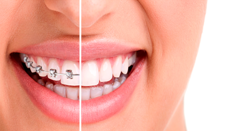 Alimentos e Bebidas Aliados (e Inimigos) do Clareamento - inspiração 1