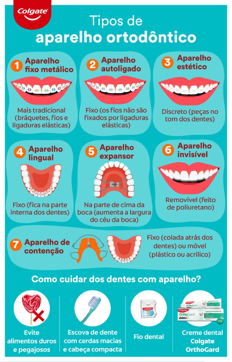 Alternativas Seguras para Clarear Dentes com Aparelho Fixo - inspiração 1