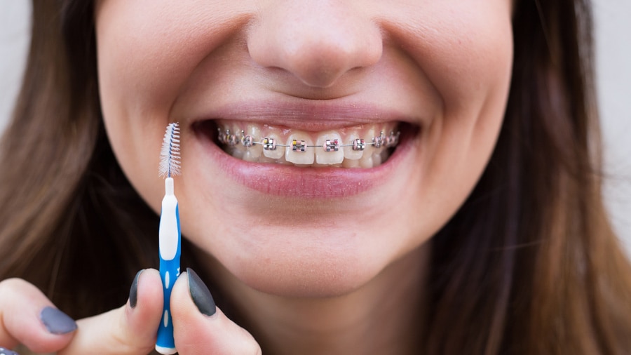 Alternativas Seguras para Clarear Dentes com Aparelho Fixo - inspiração 2