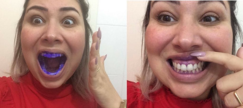 Cuidados Essenciais Pós-Clareamento: Mantendo o Sorriso Belo - inspiração 1