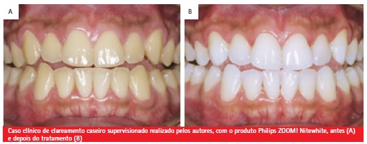 Entendendo o Clareamento Supervisionado: O que você precisa saber antes de começar - inspiração 2