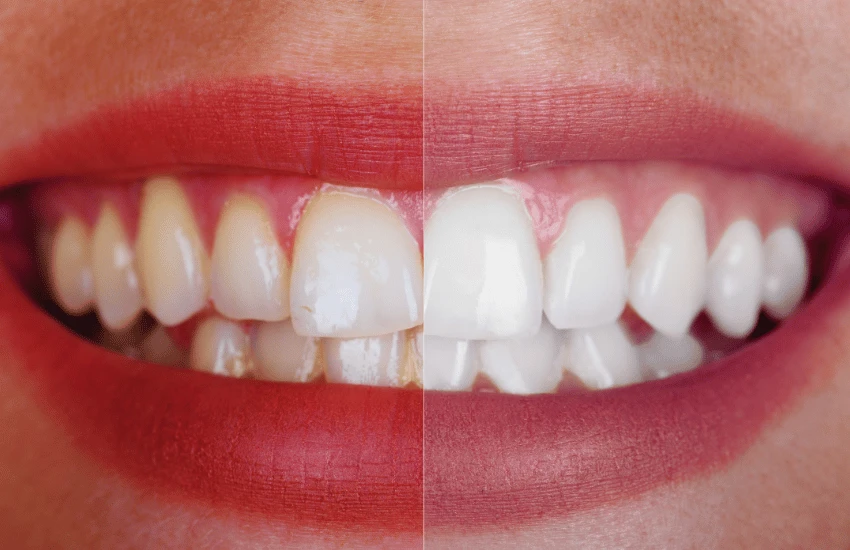 Manutenção do Sorriso Branco: Estratégias para um resultado duradouro - inspiração 1