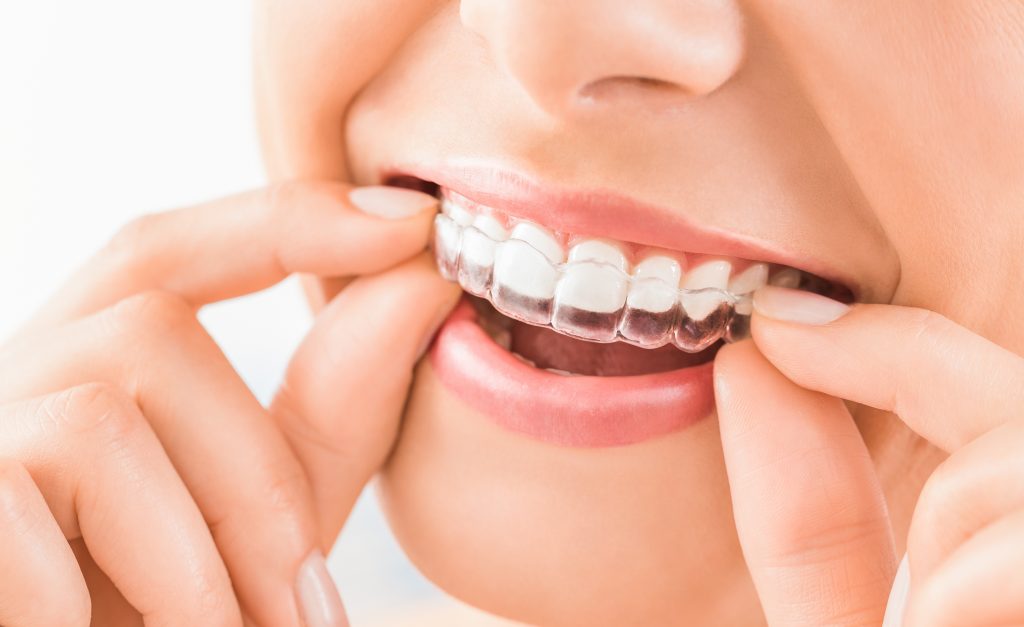 A Concentração Certa: Como o dentista define o poder do clareador para seu caso - inspiração 1