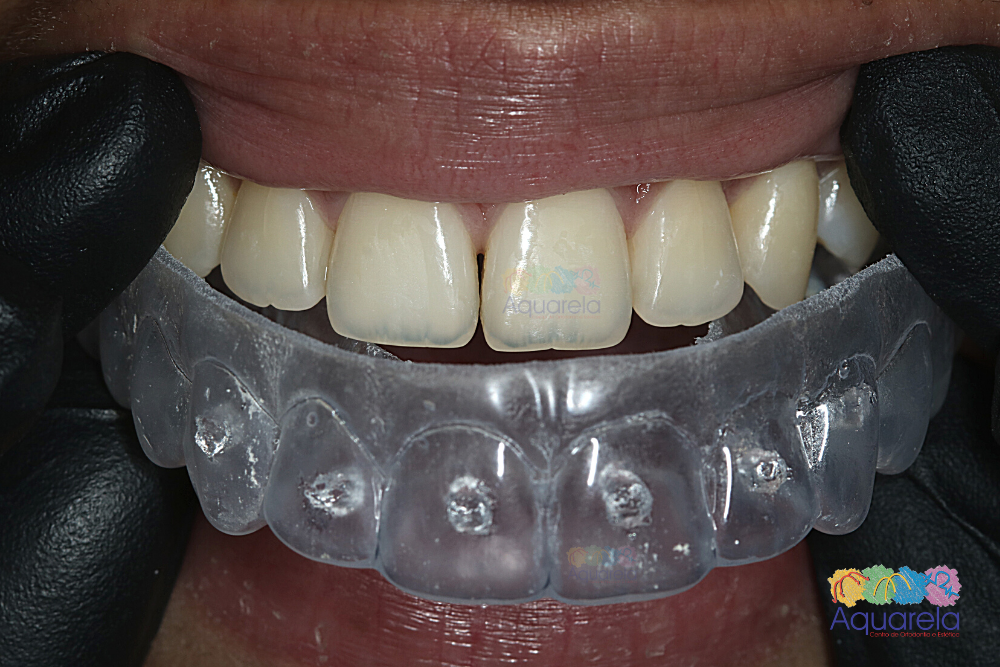 A Concentração Certa: Como o dentista define o poder do clareador para seu caso - inspiração 2