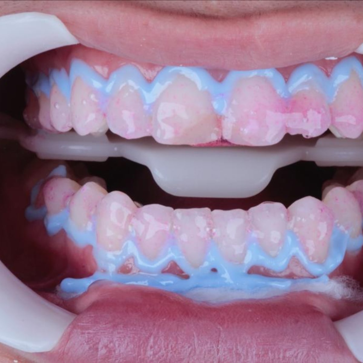 A Escolha do Agente Clareador Ideal para Você - inspiração 2