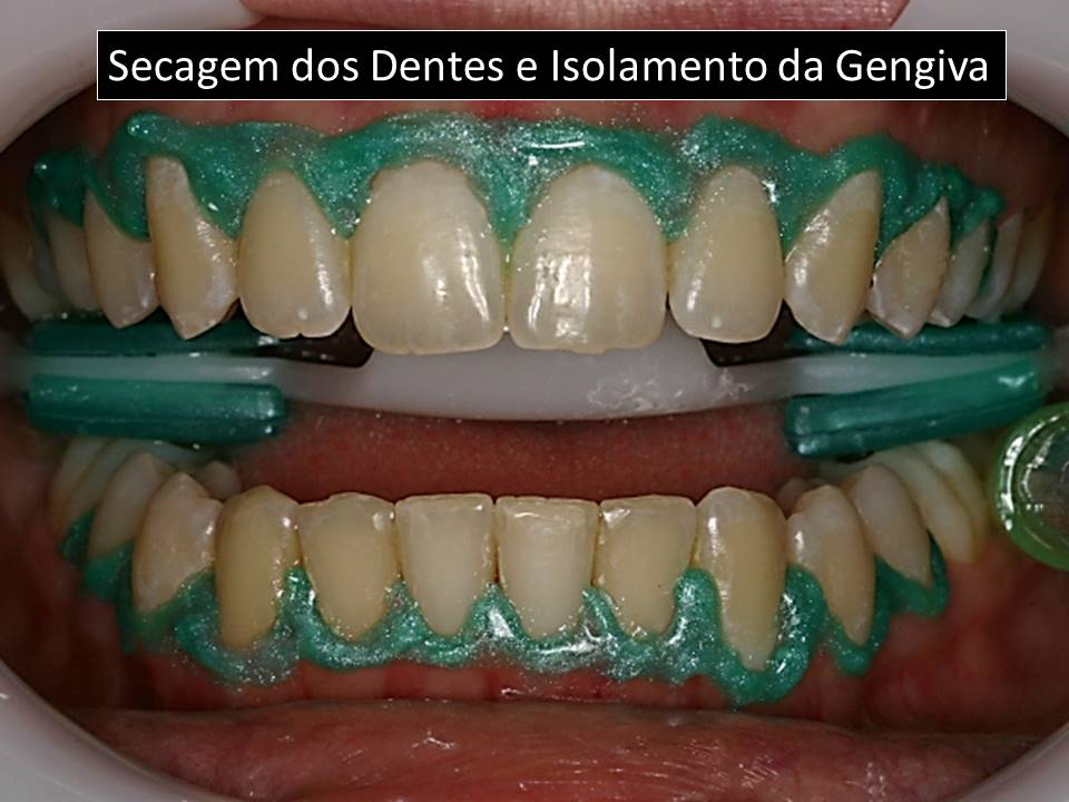 Manutenção do clareamento: Dicas para um sorriso duradouro - inspiração 2