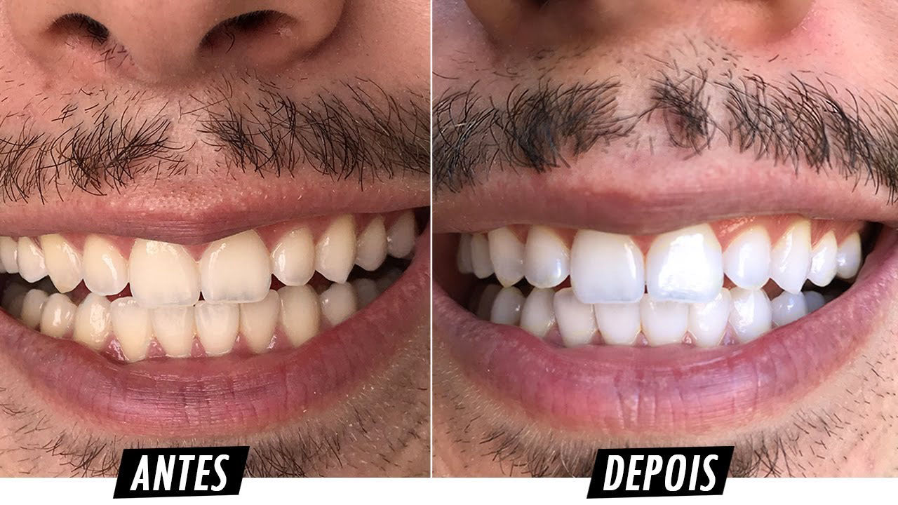 Tipos de Gel Clareador Utilizados - inspiração 1