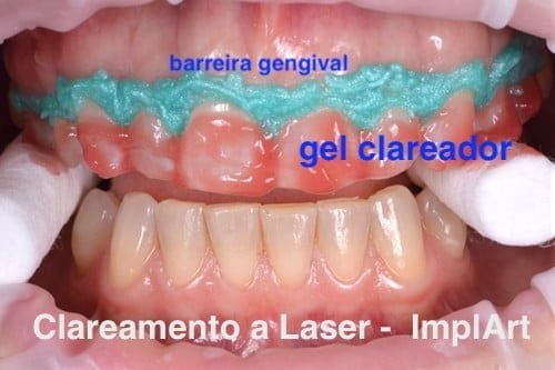 Sensibilidade Dental Pós-Clareamento: Mitos e Verdades - inspiração 2