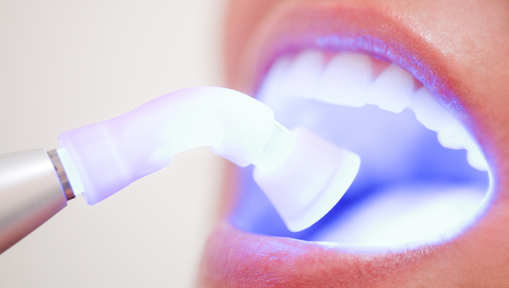 Comparativo: Laser vs. Outros Métodos de Clareamento Dental - inspiração 2
