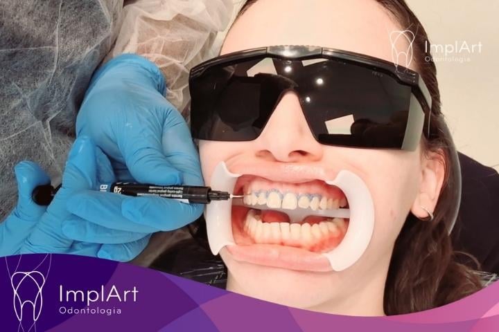 O Custo do Sorriso Perfeito: Investimento no Clareamento a Laser - inspiração 2