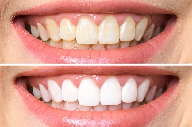 Alternativas seguras para um sorriso mais branco - inspiração 1