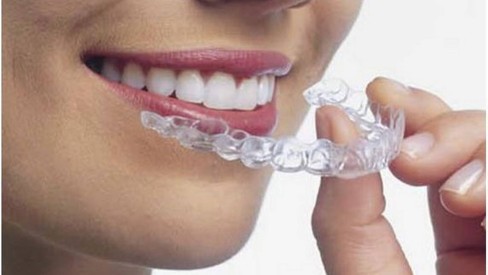 Cuidados Essenciais Durante e Após o Clareamento - inspiração 1