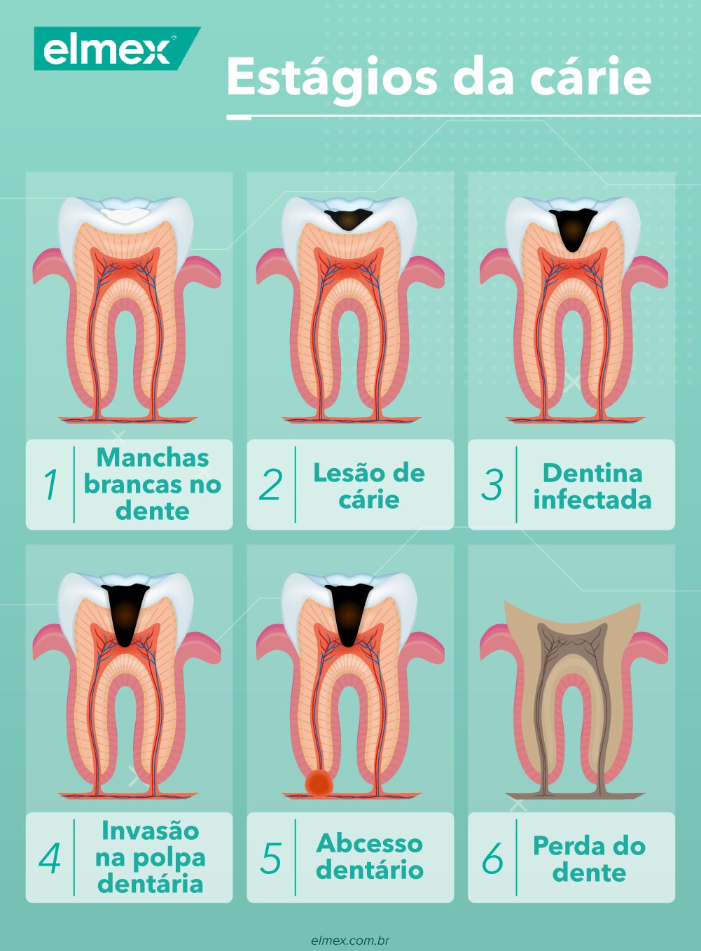 A verdade sobre a cárie em porcelana: é possível? - inspiração 1