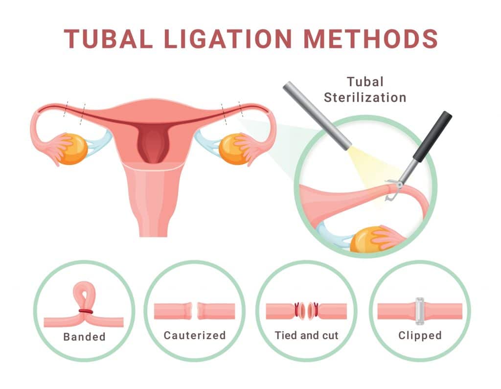 Gravidez após laqueadura: A possibilidade real - inspiração 2