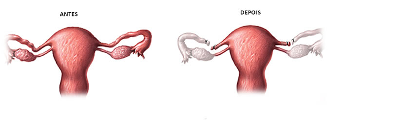 Entendendo a gravidez intrauterina após laqueadura - inspiração 1