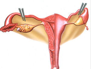 Reversão da laqueadura: Uma possibilidade distante? - inspiração 1
