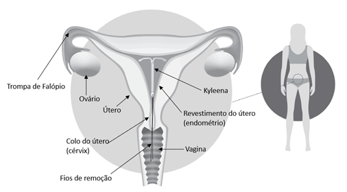 Mitos Comuns Sobre DIU e Gravidez Ectópica Desmistificados - inspiração 1