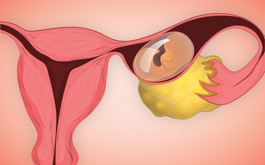 Posicionamento Correto do DIU: Chave para a Prevenção Efetiva - inspiração 1