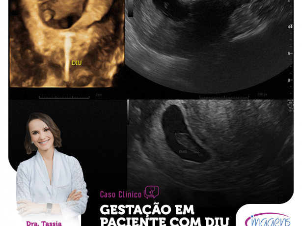 Vida Sexual e o DIU: Cuidados para Minimizar Riscos Adicionais - inspiração 1